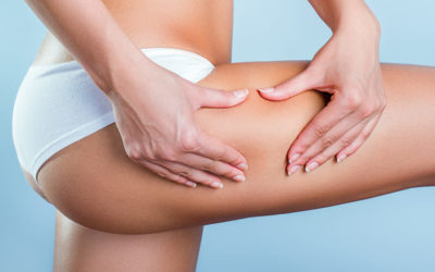 Test : Evaluer son type de cellulite